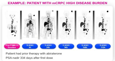 Snmmi Safety Tolerability And Dosimetry Of Tlx With Best