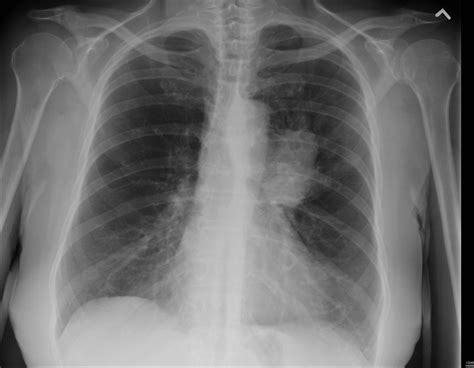 A Proposed Lung Cancer Screening Program Could Save Thousands Of Australians Per Year Thoracic