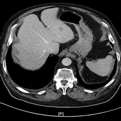 Ct Scan Of A Patient With A Hepatic Metastasis In One Case Abdominal Download Scientific