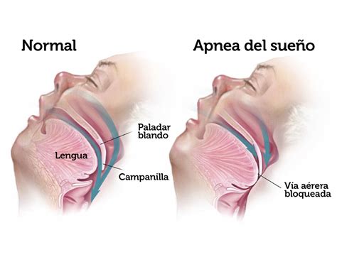 La alternativa más eficaz a la CPAP | ODOS Dental