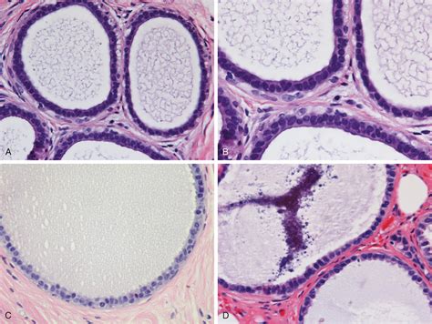 Columnar Cell Change, Flat Epithelial Atypia, and Atypical Ductal