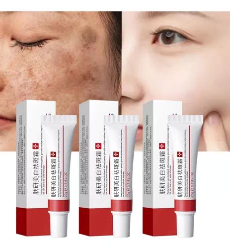 Qual Melhor Pomada Para Melasma - 3x Incrivel Creme Pomada Para Tirar Manchas Melasma | Parcelamento sem ...