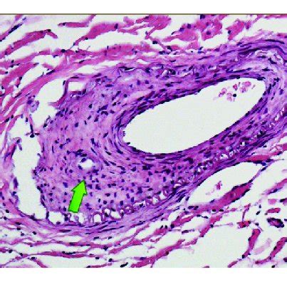 | Anterior spinal artery cervical spinal cord showing evidence of prior... | Download Scientific ...