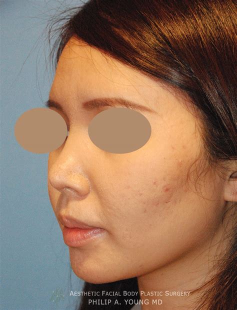 Asian Rhinoplasty Before And After Photos Seattle Bellevue