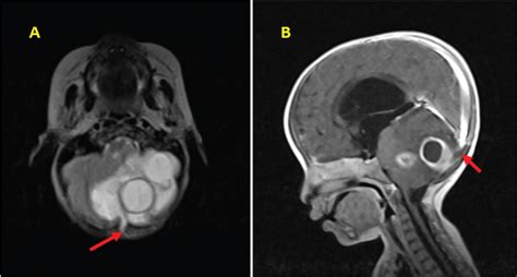 Posterior Fossa Intradural Dermoid Cyst With A Dermal Sinus