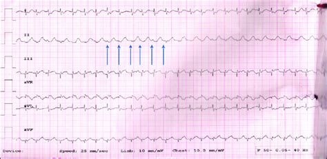 Postoperative Junctional Ectopic Tachycardia Limb Leads Only