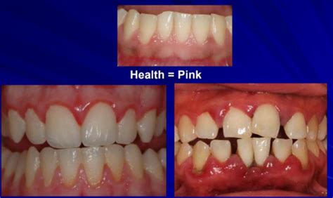 Theory Final Periodontium And Periodontal Disease Flashcards Quizlet