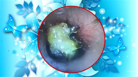 Ear Wax Removal Extraction Treatment Of Several Earwax With Sleep Music Sound Ep33 Youtube