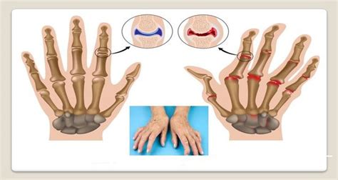 Soulager Les Douleurs De L Arthrite Dans Les Mains Avec 8 Exercices ⋆