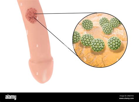 Verrugas Del Pene Genitales Y Vista De Cerca Del Virus Del Papiloma Humano Ilustración Por