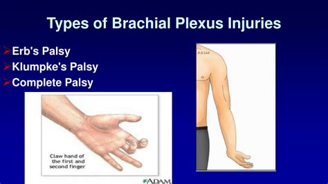 Brachial Plexus Birth Palsy