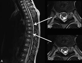 Improved Lesion Detection By Using Axial T2 Weighted MRI With Full