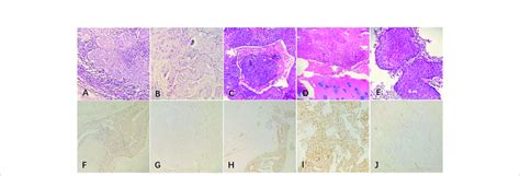 The Postoperative Pathological Examination With Hematoxylin And Eosin