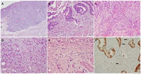 Frontiers Predicting Lymph Node Metastasis And Recurrence In Patients With Early Stage