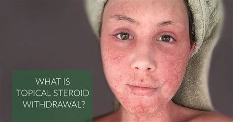 Topical Steroid Withdrawal All You Need To Know