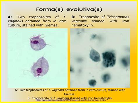 5 Trichomonas Vaginalis