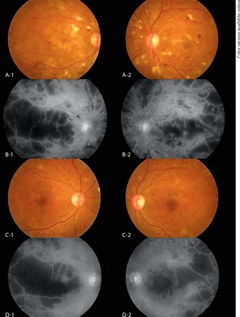 Table 1 From Pegylated Interferon Associated Retinopathy In Chronic Hepatitis Patients