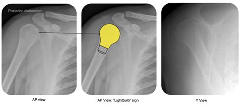 Shoulder Dislocation – OrthoSHO