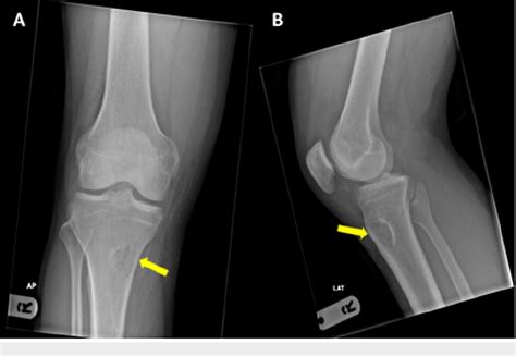 Figure 1 From Report Of A Rare Case Of Focal Depressed Fracture Of The