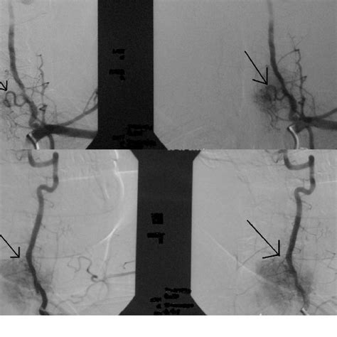 A A Left Vertebral Artery Angiogram Demonstrates A Large Artery