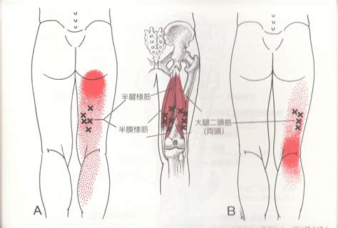 ・膝の痛み 筋筋膜性疼痛症候群・トリガーポイント施術 ラムサグループ