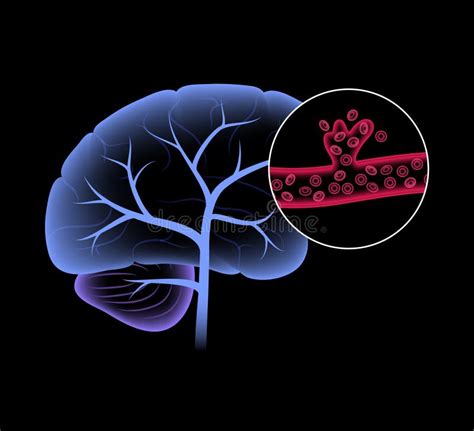 Cerebral Hemorrhage Stock Illustrations 418 Cerebral Hemorrhage Stock