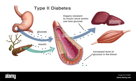 Ilustración de la producción de insulina y glucosa en la diabetes tipo