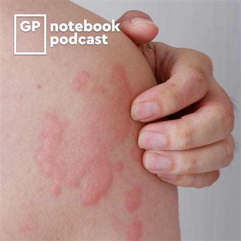 What Is Chronic Idiopathic Urticaria Hives Symptoms Causes Rash On