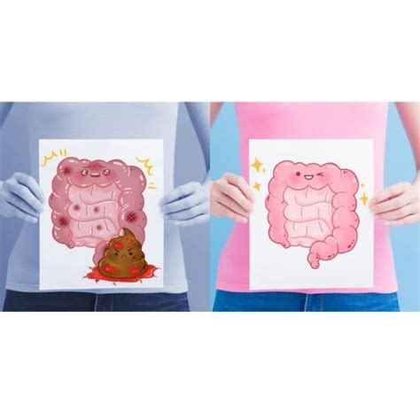 Tratamento Da Fissura Anal Isossorbida Pomada