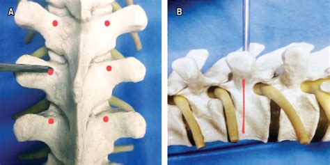 Free Hand Technique For Placement Of Transpedicular Screws In Thoracic