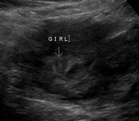 Ultrasound Photos To Determine If The Sex Of Your Baby Is A Girl Artofit