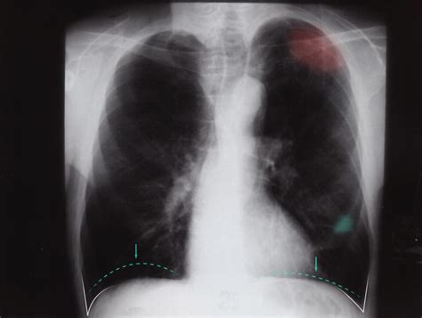 Copd Chest X Ray Frequency