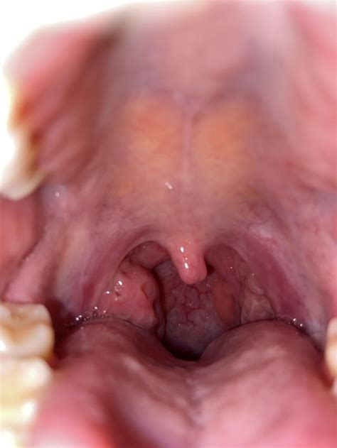 What’s Wrong With My Tonsil 1 Enlarged Tonsil For 8 Months Now Looks Like It May Be Getting