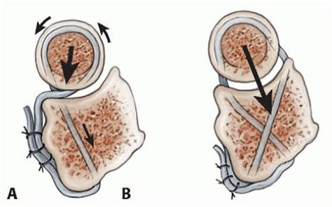 Extensor Tendon Centralization Following Traumatic Subluxation At The