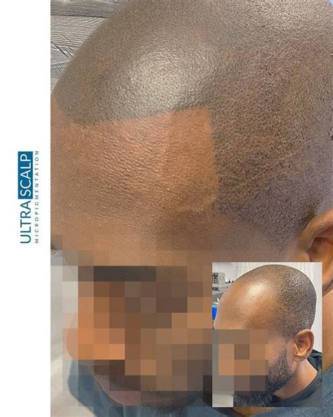 Is Scalp Micropigmentation Safe To Get?