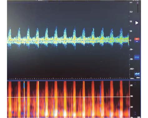 Application Of Electroencephalogram Short Latency Somatosensory Evoked