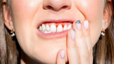 How To Treat Periodontitis At Home