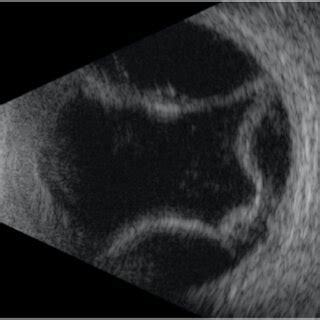 B-scan ultrasound of the right eye from initial visit. T6E view showing ...