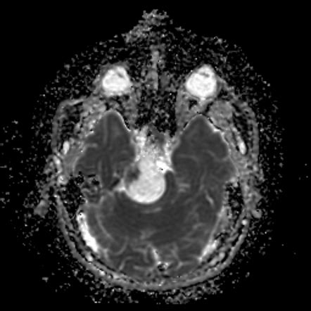 Trigeminal Cystic Schwannoma Image Radiopaedia Org