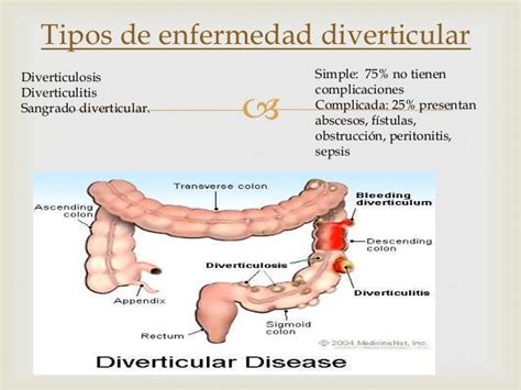 Exposición De Cirugía Diverticulitis Y Diverticulo De Zenker