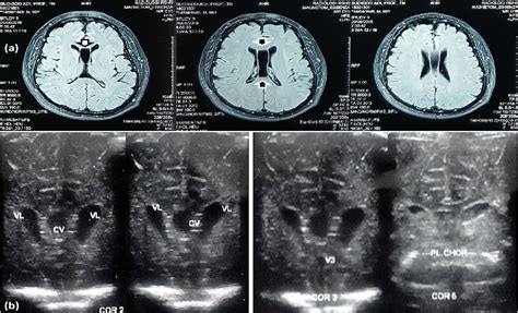 Figure From Incidence Of Cavum Septum Pellucidum And Cavum Vergae In