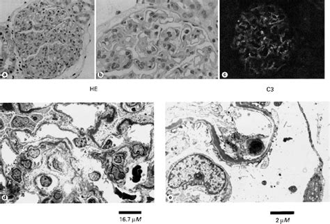 Figure 1 From Cyclosporin A Treatment For Membranoproliferative Glomerulonephritis Type Ii