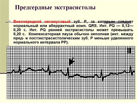 Нарушение сердечного ритма. Аритмии и блокады сердца - презентация онлайн