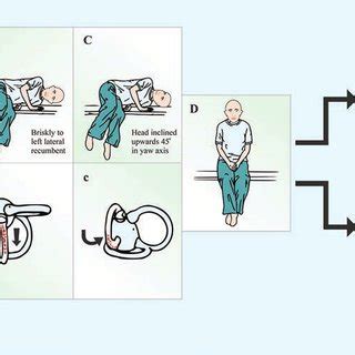 Gufoni maneuver for the left posterior arm horizontal semicircular ...