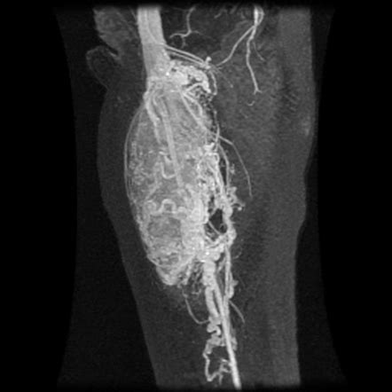 Alveolar soft part sarcoma | Radiology Case | Radiopaedia.org