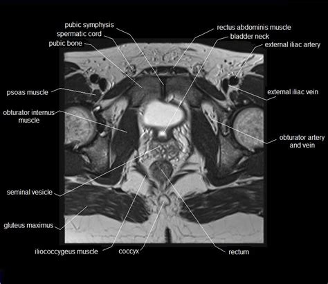 Pelvic Muscles Anatomy Mri – NBKomputer