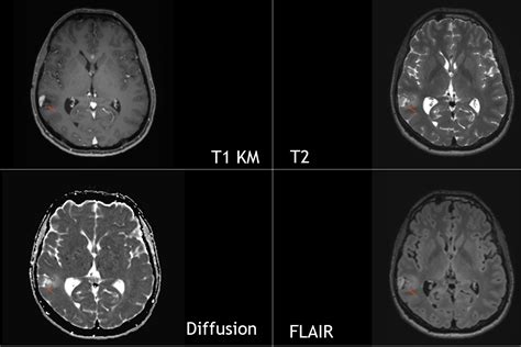 Pilocytic astrocytoma MRI