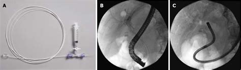 Figure 1 From Diagnostic And Therapeutic Direct Peroral Cholangioscopy