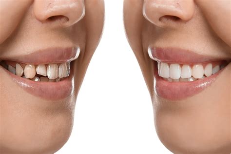 Invisalign Before And After Everything You Need To Know About First