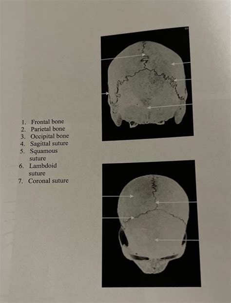 Solved 1 Frontal Bone 2 Parietal Bone 3 Occipital Bon